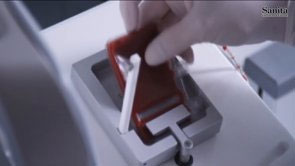 Staminali cordonali, un’altra storia di speranza grazie al trapianto autologo