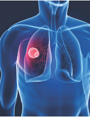 Cancro, inaugurata piattaforma per diagnosi precoce (SCED). Analizza geni e mutazioni