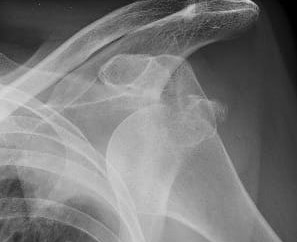 IRCCS Galeazzi: primo studio sulle tecniche mininvasive per cura calcificazioni alla spalla