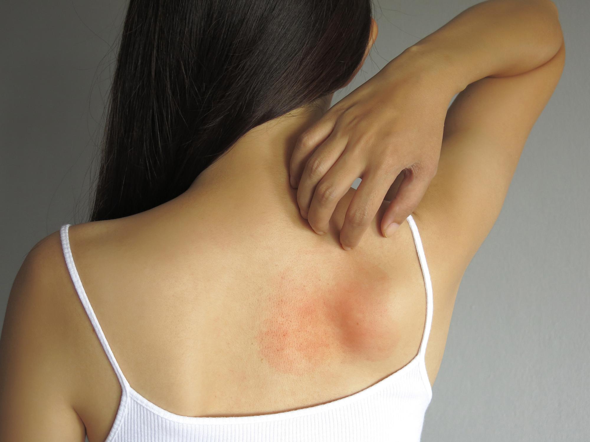 Dermatite atopica, il binomio  “inquinamento e cute” ne spiega il trend in aumento