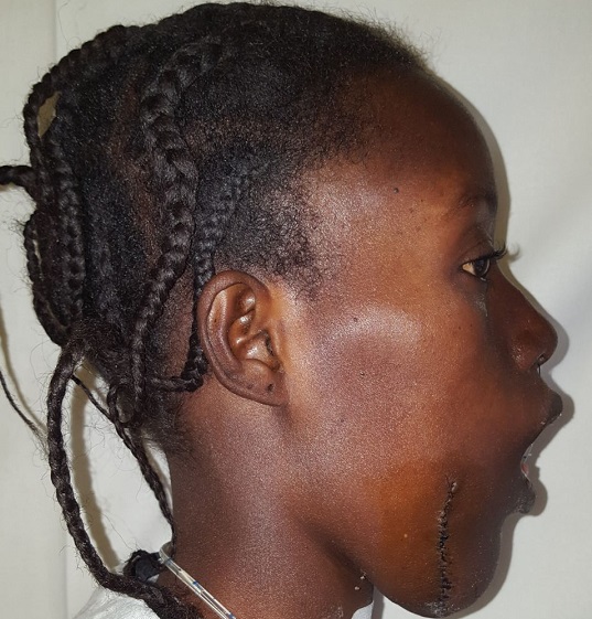 Ricostruita la mandibola di Mame, la giovane senegalese salvata da Emergenza Sorrisi e dalla Fondazione Policlinico Gemelli