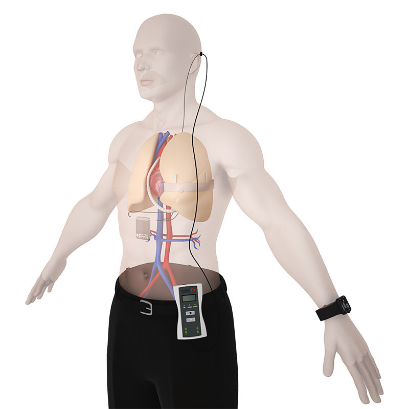 Cardiologia, impiantato il primo cuore artificiale “wireless”. Massetti (Gemelli): «L’alimentazione senza fili ricarica il cuore in due ore e riduce il rischio di infezioni»