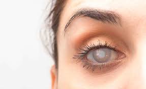 Cataratta: un unico intervento con laser per recuperare anche miopia, ipermetropia, astigmatismo o presbiopia