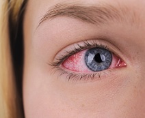 Virale, batterica o allergica. Per ogni congiuntivite la giusta cura