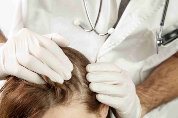 Caduta dei capelli e alopecia: di cosa si tratta