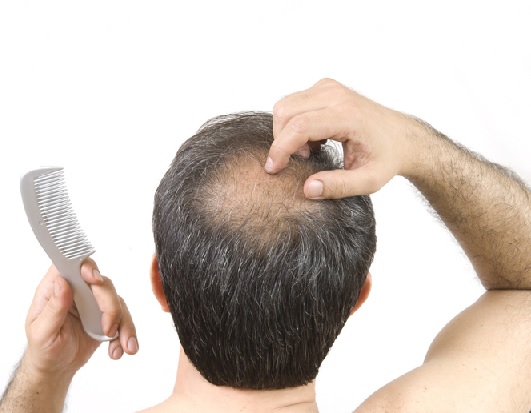 Alopecia areata grave, una terapia efficace che favorisce la ricrescita anche di ciglia, sopracciglia e peli