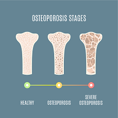 Osteoporosi, alimentazione corretta e attività fisica per prevenirla fin di piccoli