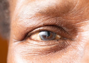 Quali sono i sintomi della cataratta?