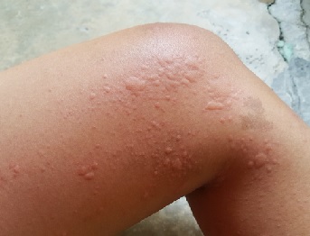 orticaria da pressione de ce articulatiile se doare in timpul exercitiului