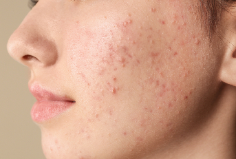 Lo stigma dell’acne da adulti, studio rivela i «danni» all’autostima e alla fiducia in sé