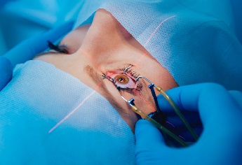 Correzione miopia: quando si può operare?