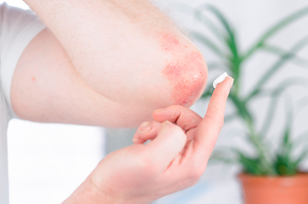 Dermatite atopica: i corticosteroidi si confermano i pilastri del trattamento