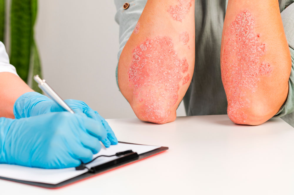 Dermatite atopica, Patrizi (Uni Bologna): «Ne soffrono persone di tutte le età»