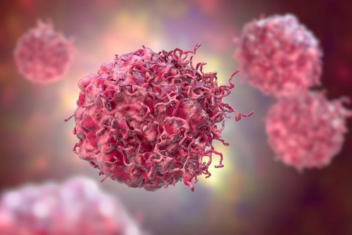 Neuroblastoma: con il protocollo PREME cure “su misura” per i pazienti pediatrici