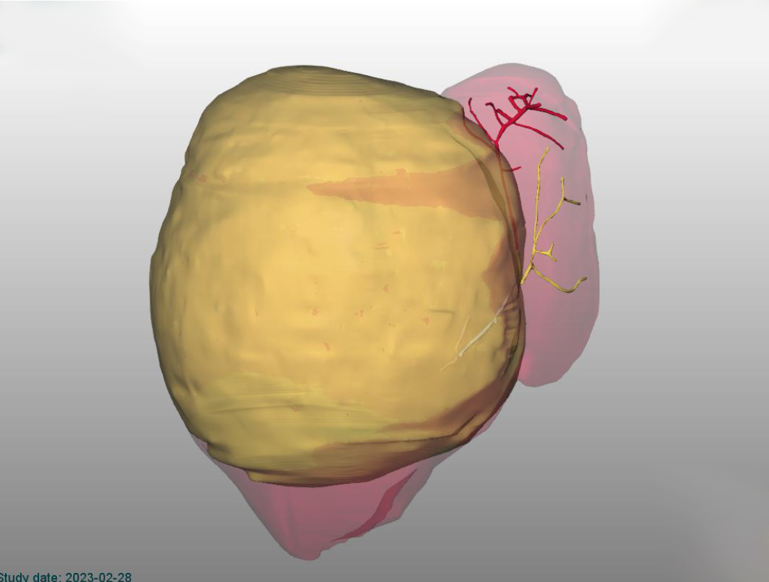 Asportato un tumore di 2 kg dal fegato di una bimba di 10 mesi. L’intervento al Bambino Gesù