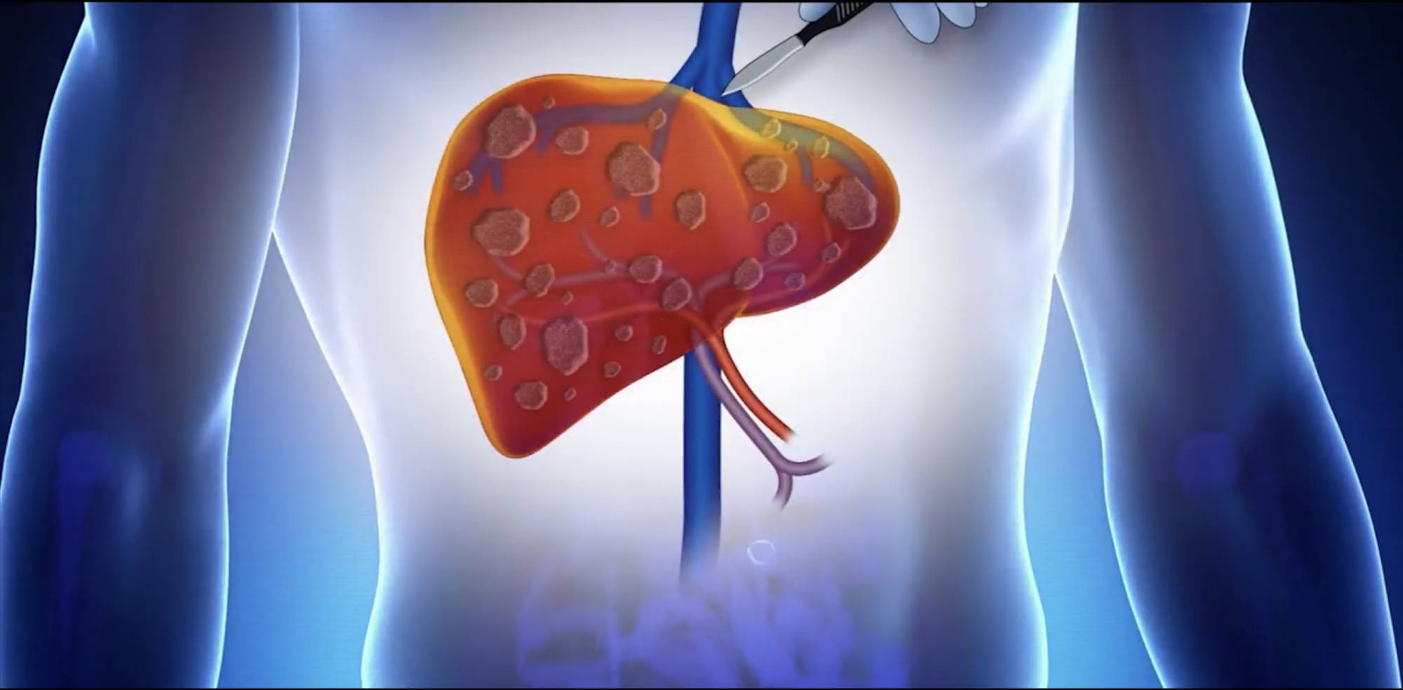 Colangite biliare primitiva: parere positivo CHMP dell’EMA per seladelpar