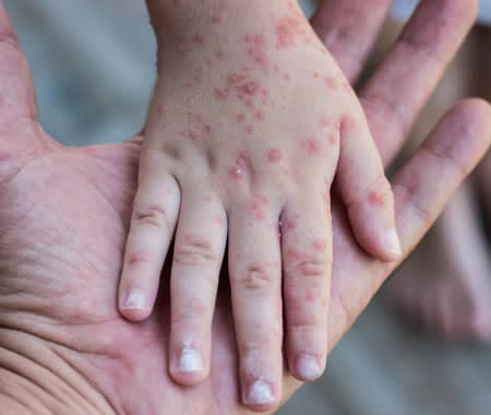 Rosolia, Oms: «L’Italia l’ha eliminata, non è più endemica»