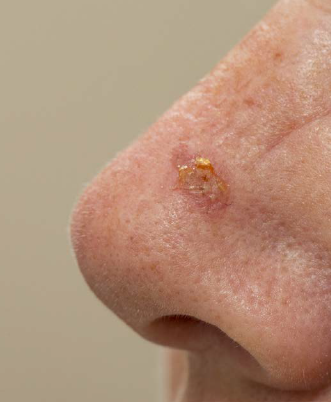 Al via la campagna “Derma point, facciamo il punto  sulla cheratosi attinica”