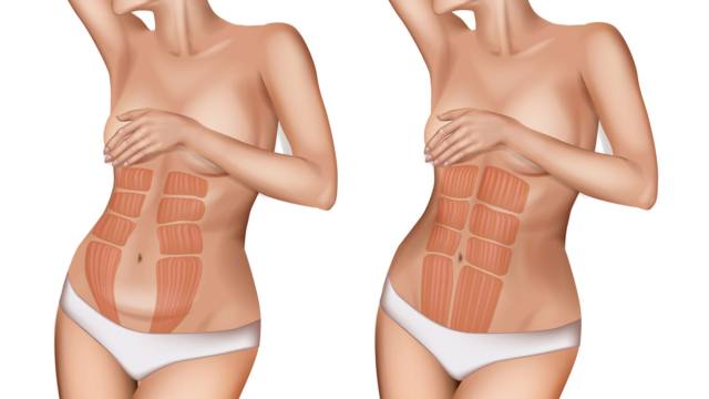 Diastasi addominale, patologia sottovalutata e sottostimata