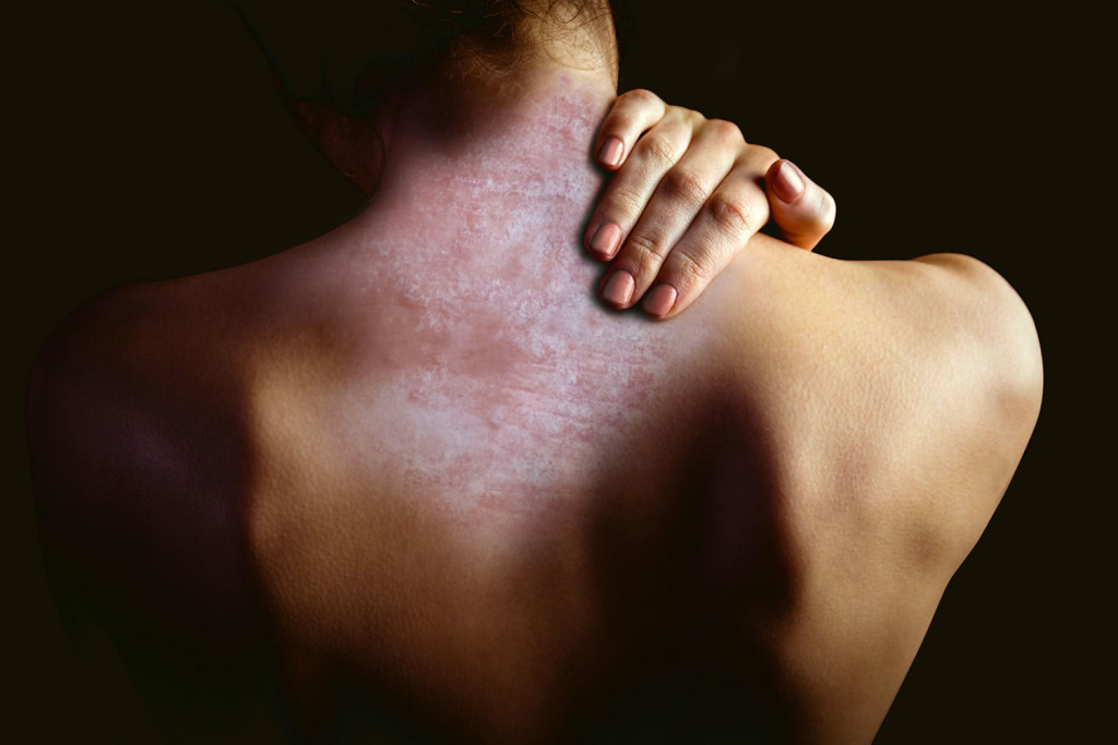 Giornata Mondiale della Psoriasi, Corazza (APIAFCO): “Garantire accesso a cure innovative a tutti i pazienti”