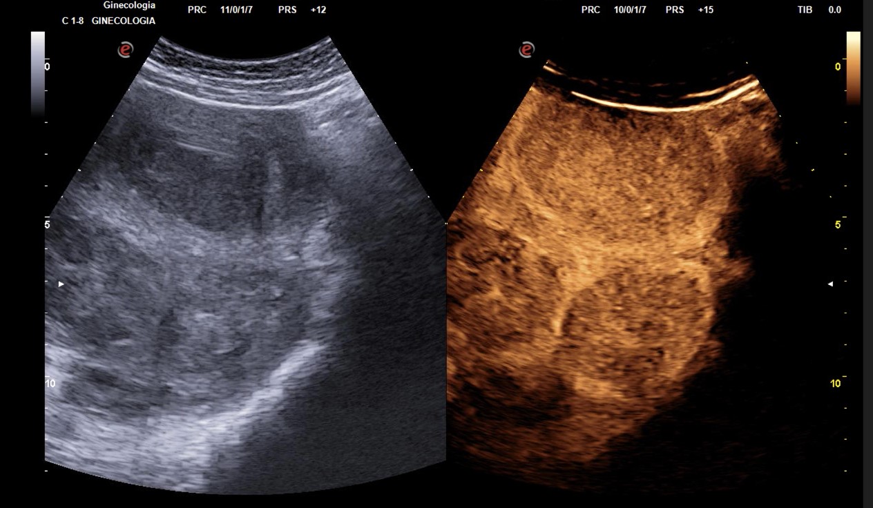 Fibromi uterini, tecnica mininvasiva evita ricovero e taglia tempi guarigione