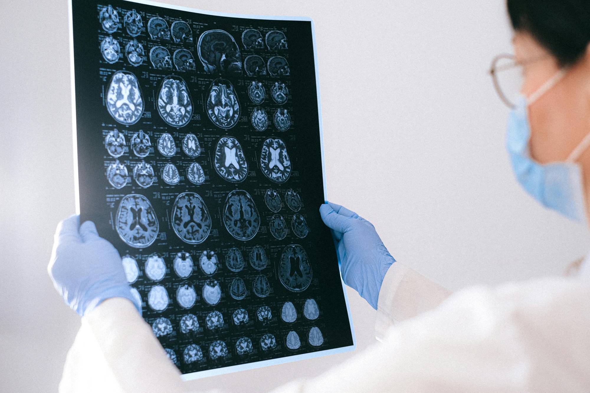 Alzheimer, la PET anticipa la diagnosi: funziona anche quando i test cognitivi non rivelano nessun declino