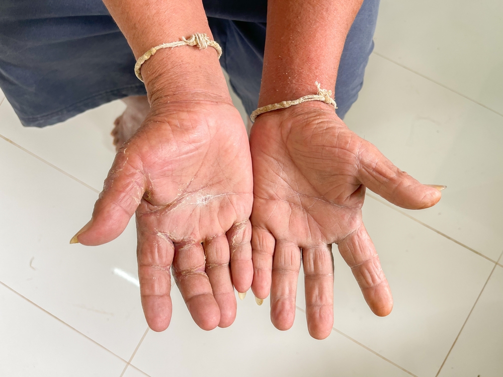 Giornata Mondiale della Sclerodermia, APMARR: “Al via il giro d’Italia della prevenzione”