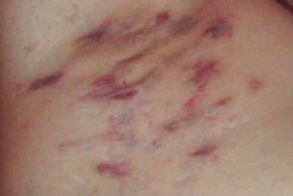 Idrosadenite suppurativa: via libera alla rimborsabilità di secukinumab