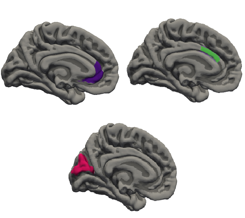 Emicrania, scoperte nuove ‘impronte’ nel cervello e nell’intestino dei bambini