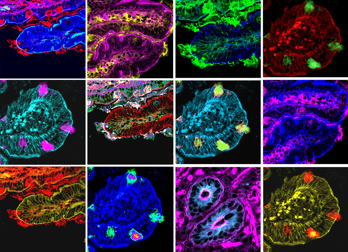 Emicrania, scoperte nuove ‘impronte’ nel cervello e nell’intestino dei bambini