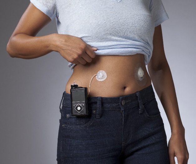 CALDO E DIABETE: COSA INSEGNA IL CASO ZVEREV E COME PROTEGGERE GLICEMIA E SENSORI IN ESTATE