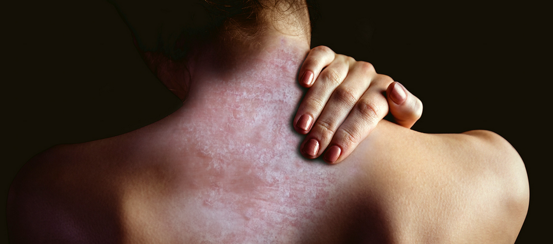 Piano Nazionale Cronicità, APIAFCO: “Includere la psoriasi può sanare un’ingiustizia sociale che penalizza quasi 2 milioni di pazienti”
