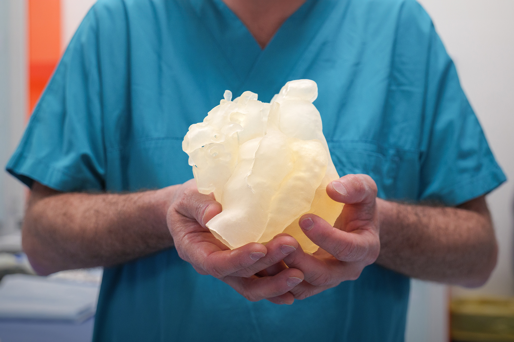 Nato con il ‘cuore a metà’, intervento salvavita al Bambino Gesù di Roma