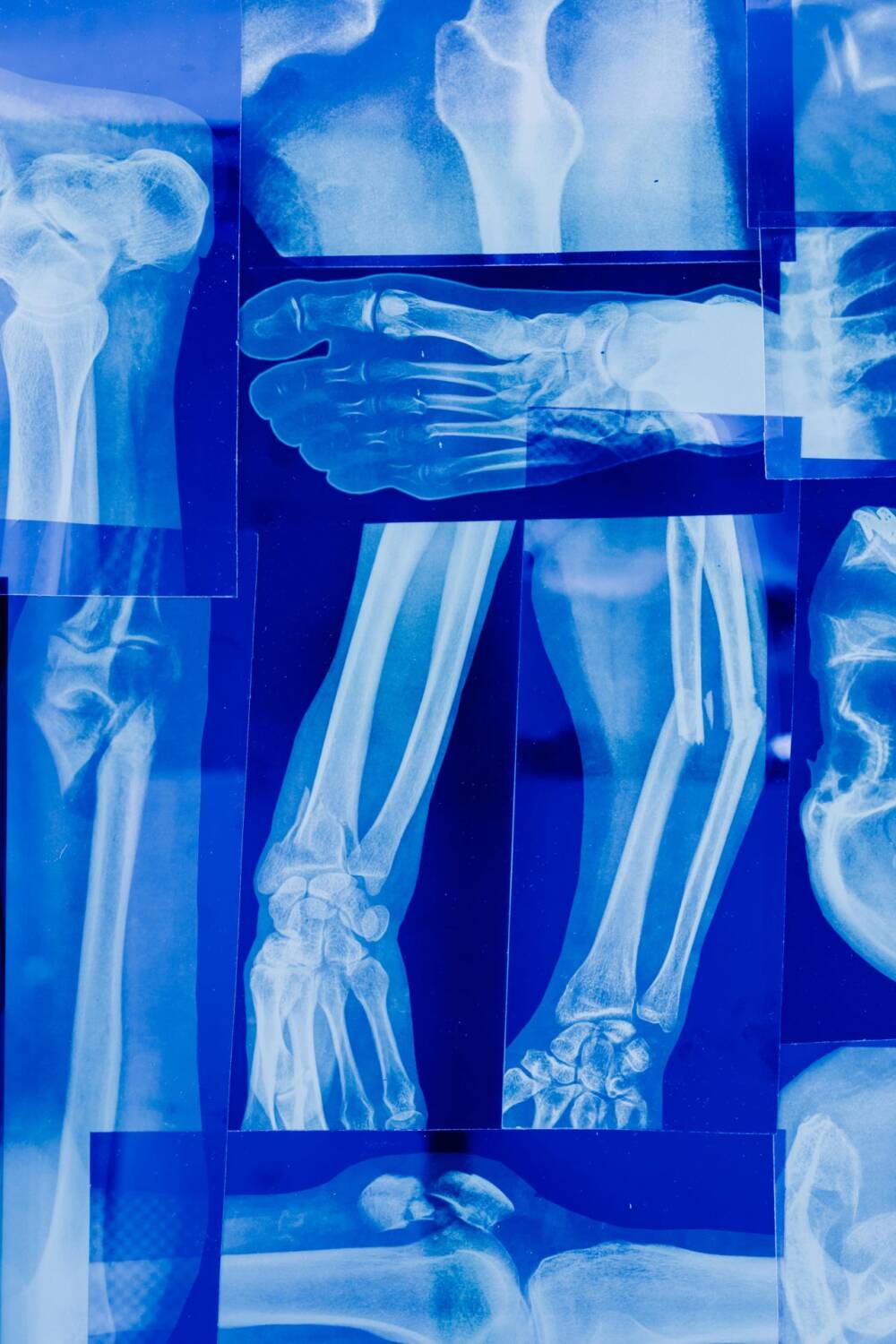 Osteopatia diabetica, fino al 37% dei giovani con diabete di tipo 1 ha la massa ossea ridotta