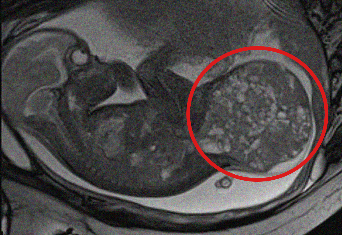Dalla diagnosi prenatale al successo chirurgico: il caso del teratoma sacro-coccigeo da 800 grammi