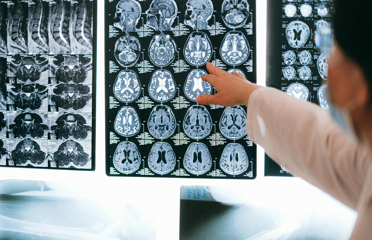 DIABETE, IN CALO LA MORTALITA’ PER ICTUS, MA ANCORA TROPPE DISUGUAGLIANZE